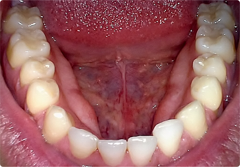Image taken by intraoral camera at Tampa dentist office