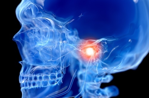 Side view of skull highlighting TMJ jaw pain and joint inflammation in Carrollwood Village, FL