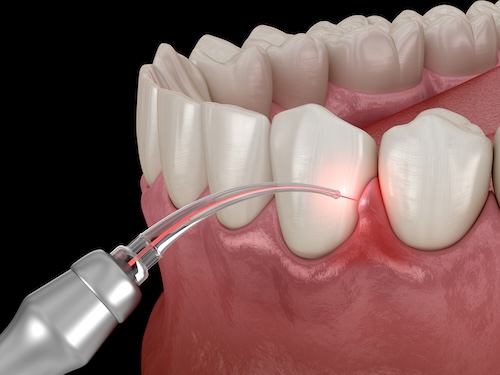 Dental laser treating gum disease during laser gum therapy in Carrollwood Village, FL