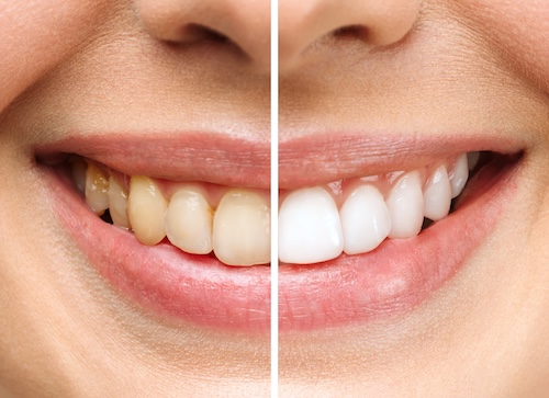 Professional teeth whitening before and after comparison at dentist in Carrollwood Village, FL