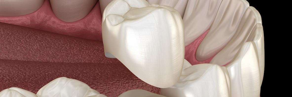 Diagram of Dental Crowns from Carrollwood Village Dental in Tampa, FL