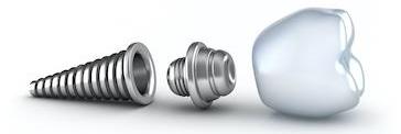 Diagram of a dental implant at Carrollwood Village Dental