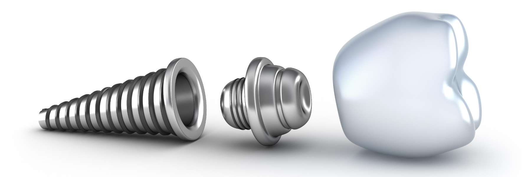 An illustration of Dental implant screw in Tampa, FL