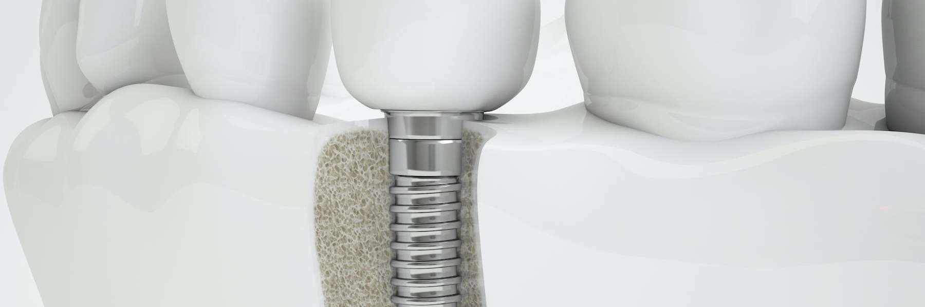An illustration of a dental implant in Tampa, FL