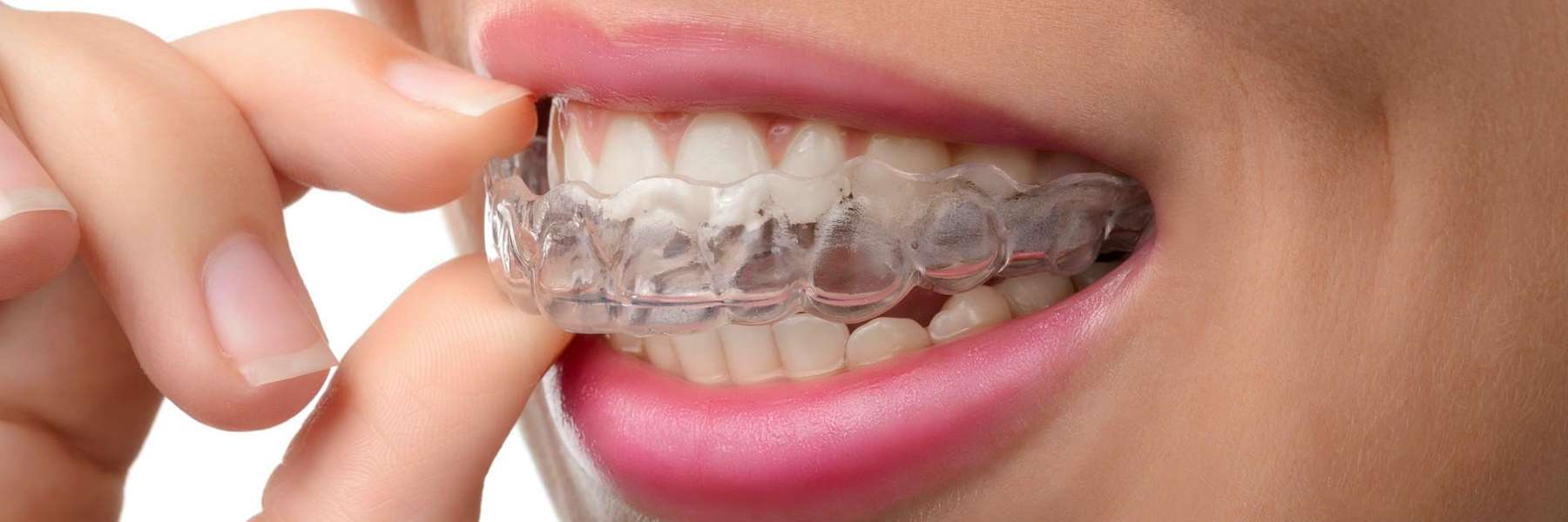 Lady placing Invisalign aligners on her teeth in Tampa, FL