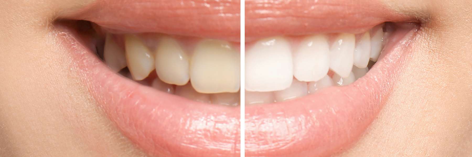 A before and after results of Professional Teeth Whitening in Tampa, FL