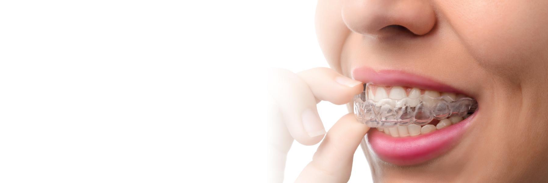 Invisalign® Tampa FL Carrollwood Village Dental