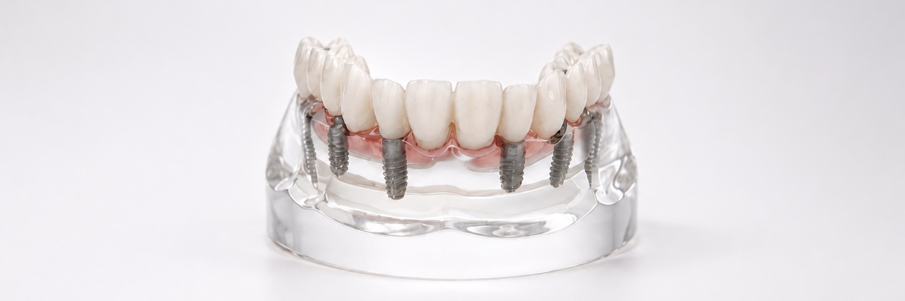 Woman smiling wearing dental implants near Carrollwood