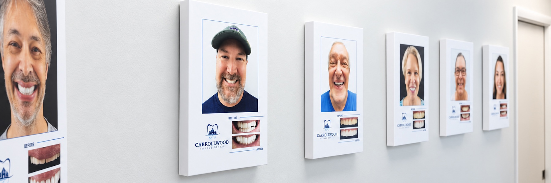Porcelain Veneers | Dentist