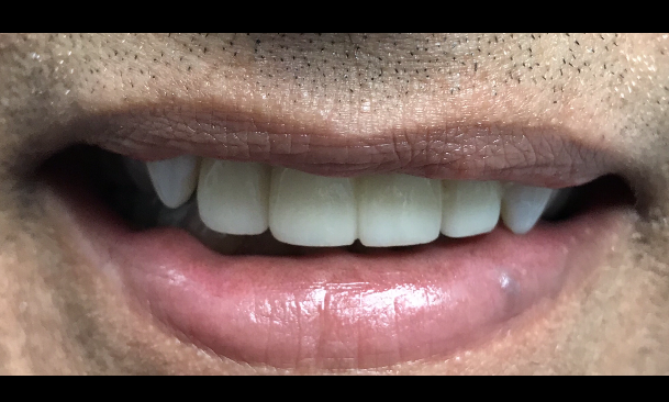 Results from cosmetic dentistry and dental bridge placement in 33624