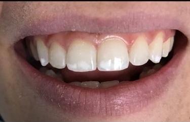 Cosmetic-Bonding-After-Image