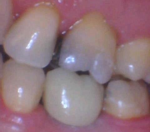 After photo of dental patient in Tampa with a new dental implant