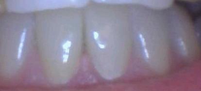 Results from procedure for ceramic dental crowns in Tampa FL