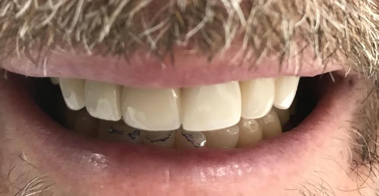 A-Dental-Implant-Filled-the-Gap-After-Image
