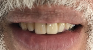 Close up of patients smile after dental implant placement in Tampa FL