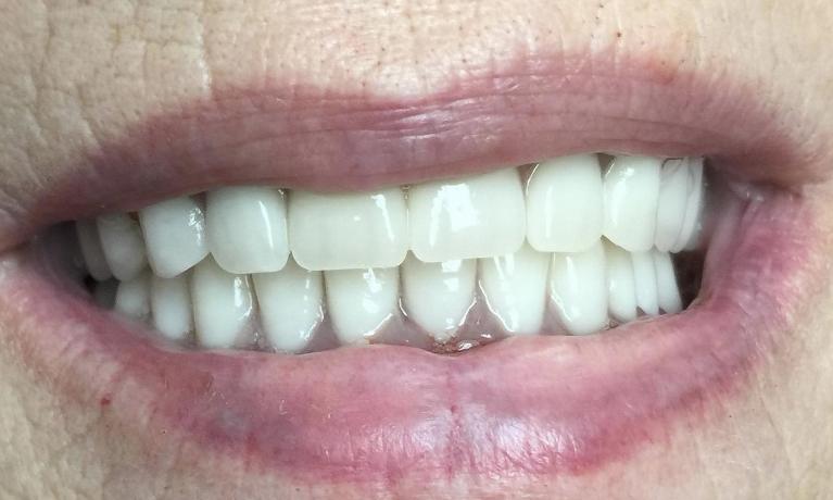 I-Can-Smile-Again-After-Image