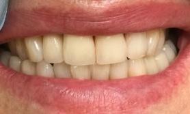 Patient after front tooth replacement in Tampa, FL