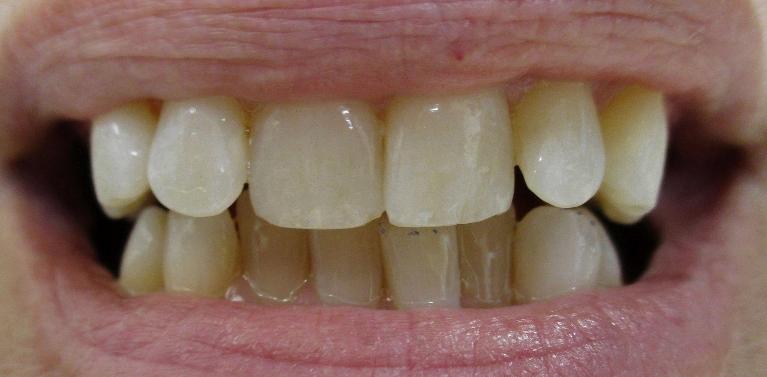 Patient teeth after cosmetic teeth contouring in Tampa