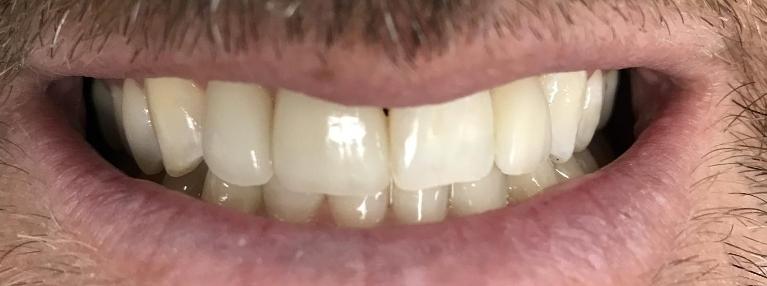 Close up of results from procedure for porcelain veneers in Carrollwood Village