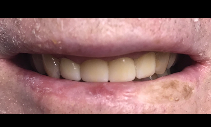 Results from cosmetic dentistry at Carrollwood Village dentist office