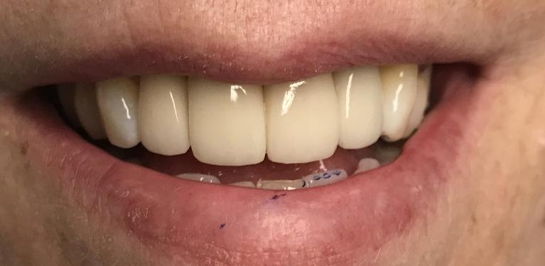 Results from dental crowns and implants in Tampa FL