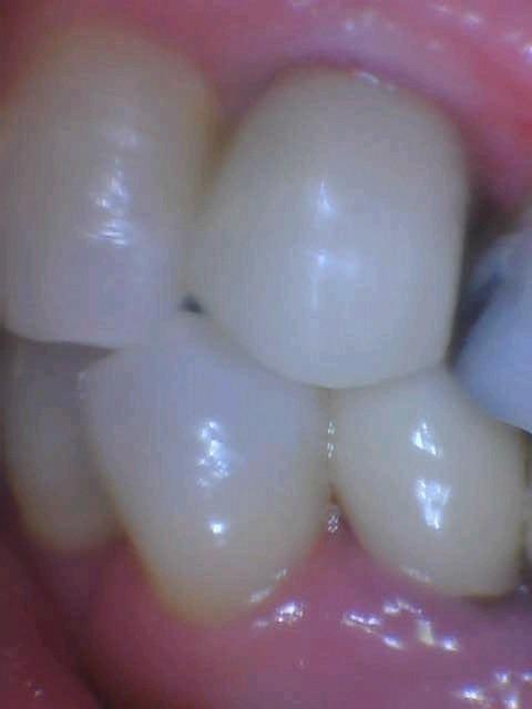 Results from dental implant placement at Tampa FL dentist office