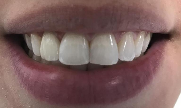 Results from procedure for dental crowns at 33624 dental office