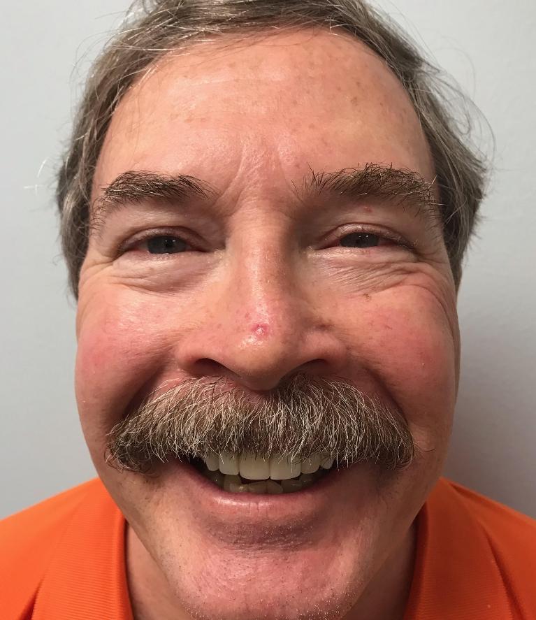 Happy patient after a front tooth replacement in Tampa