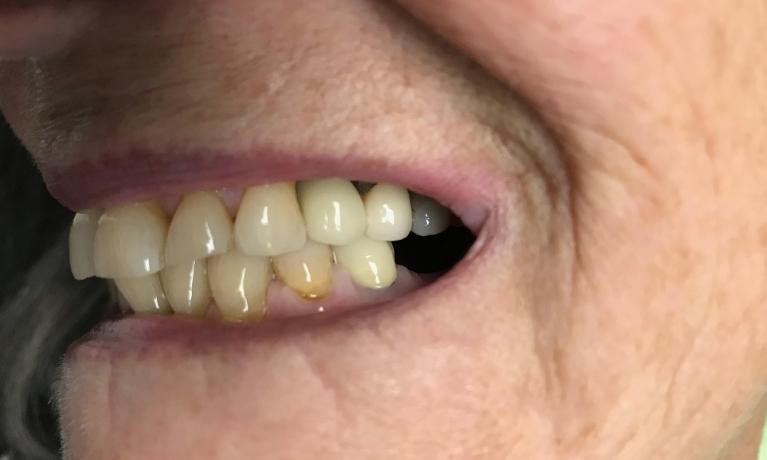 A dental patient after getting a dental implant