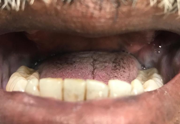 Patient with missing teeth in Tampa