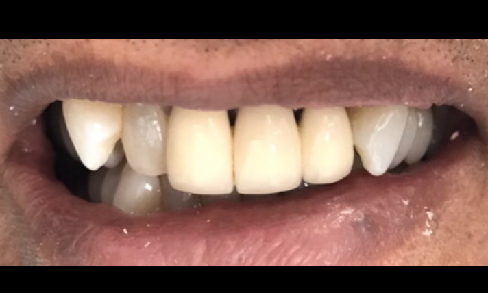 Patient with discolored teeth and ill fitting dental bridge at Carrollwood Village Dental