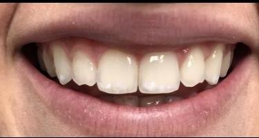 Cosmetic-Bonding-Before-Image