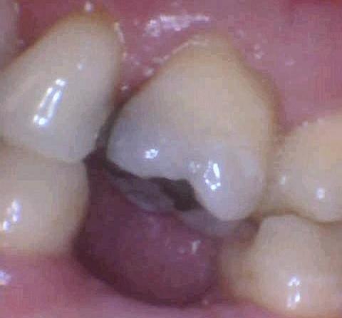 Tampa dental patient with a missing tooth