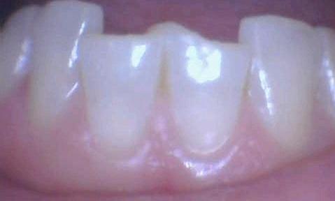 Close up of fractured bottom teeth from dental emergency near 33624
