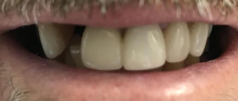 A-Dental-Implant-Filled-the-Gap-Before-Image