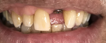 Close up of dental patient with missing front tooth at Tampa dentist office
