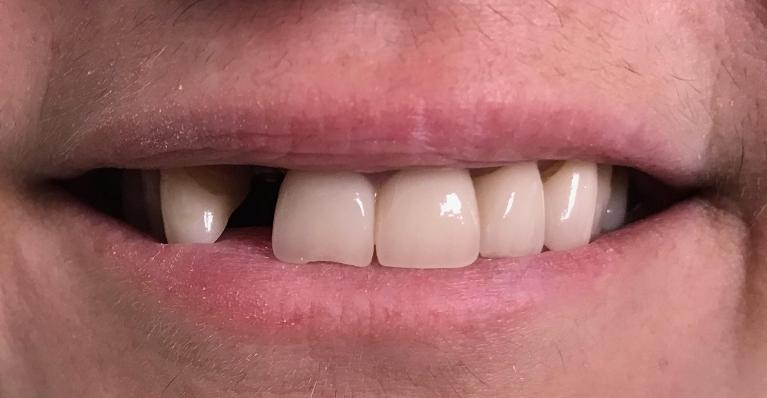 A smile with a missing tooth