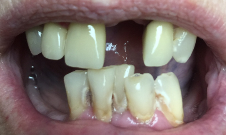 I-Can-Smile-Again-Before-Image