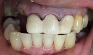 I-Need-a-New-Smile-for-My-Daughter-s-Wedding-Before-Image