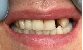 A patient with a missing tooth in Tampa