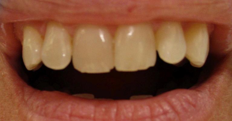 Cosmetic dentistry patient in Tampa