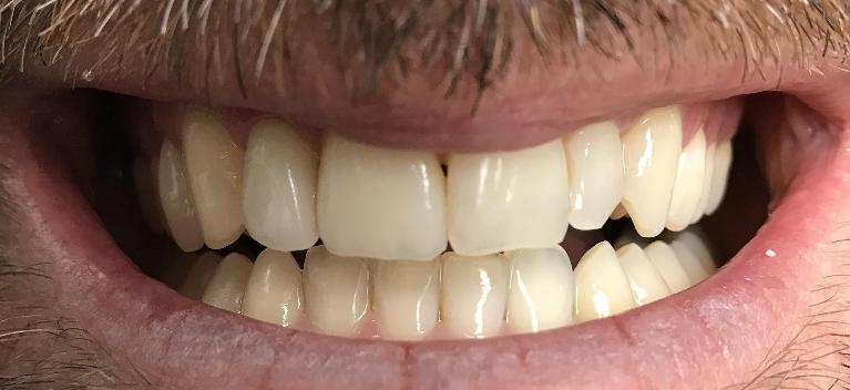 Close up of dental patients smile before porcelain veneers at Tampa cosmetic dentist office