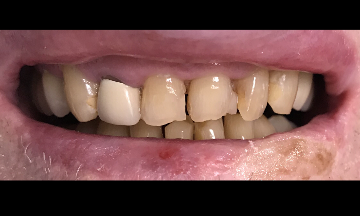 Close up of patient with broken teeth at dentist office in Tampa