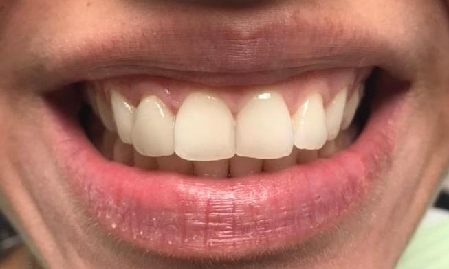 Close up of patient smile before dental crowns in Tampa FL