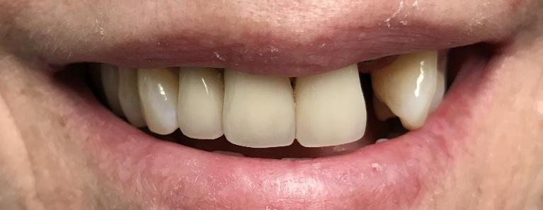 Close up of patient smile before dental crown replacement in Carrollwood FL