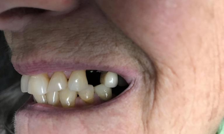 A dental patient with a gap in her smile in Tampa, FL