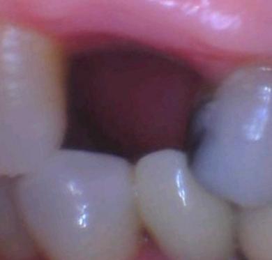Close up of patients mouth with missing tooth at dentist office in Tampa
