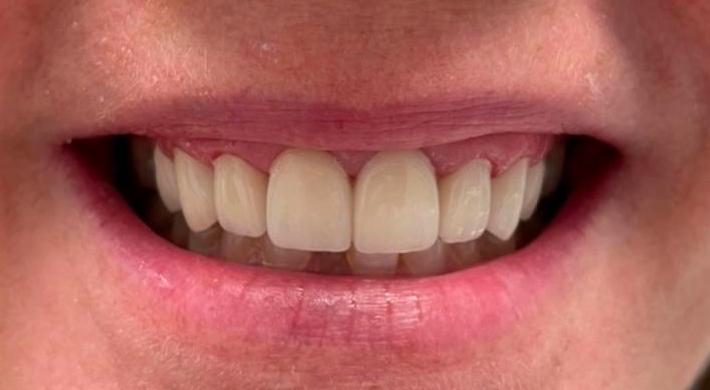 Old veneers replaced with dental crowns in Tampa FL