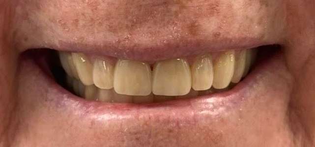 After photo of natural-looking ceramic crowns done in Tampa FL