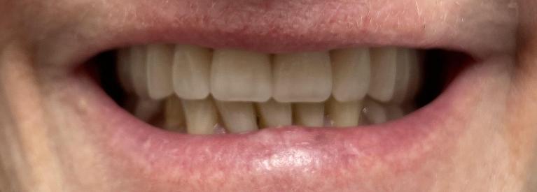 Smile-Makeover-with-a-new-Denture-After-Image